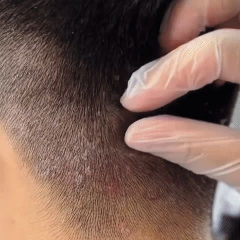 Escamas adheridas en la nuca